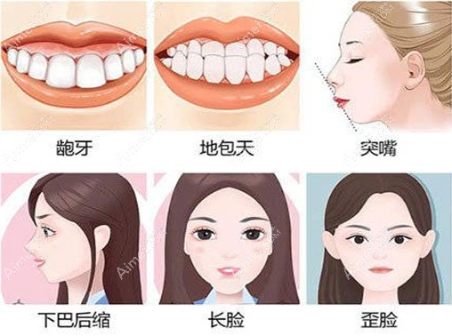 何锦泉正颌得多少钱?广州何锦泉做凸嘴正颌4-6万起,疗效真好