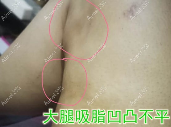 今日任学会吸脂修复价格:是贵但任学会抽脂修复靠谱能信任