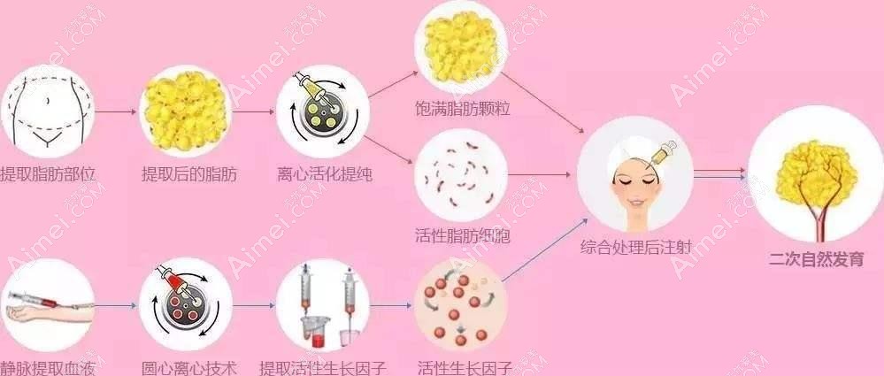 冯斌是国内较早开展脂肪填充的医生 冯斌是国内较早开展脂肪填充的医生