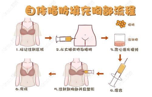 孙泽芳是北京自体脂肪丰胸技术好的医生 孙泽芳是北京自体脂肪丰胸技术好的医生