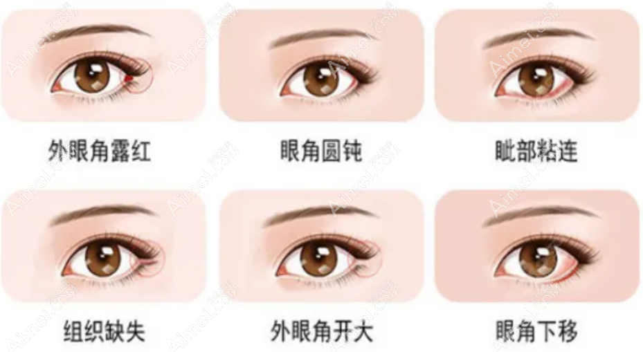 张冰洁医生内眼角/外眼角修复价格多少钱 张冰洁医生内眼角/外眼角修复价格多少钱
