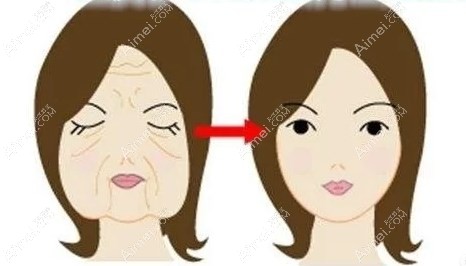 v美减龄面部提升前后对比图片爱美网 v美减龄面部提升前后对比图片爱美网