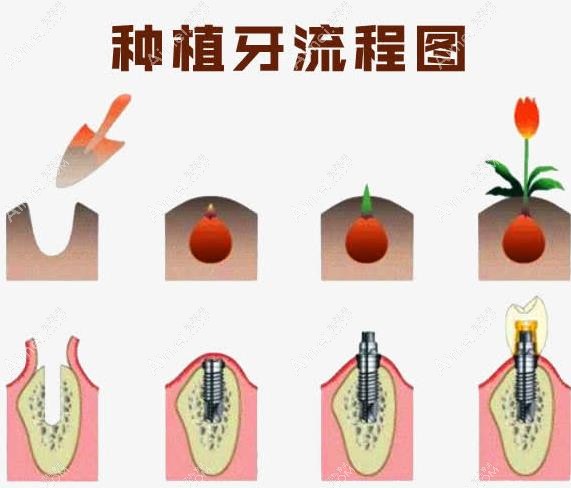 瞿磊医生种植牙技术怎么样
