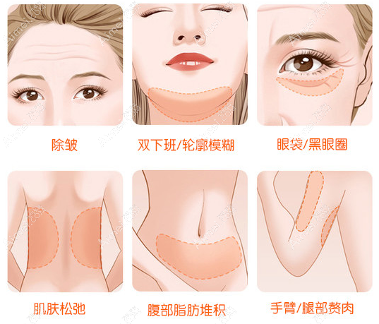 北京华韩拉皮手术价目表:瞿健拉皮价格38000+/技术好/有特色