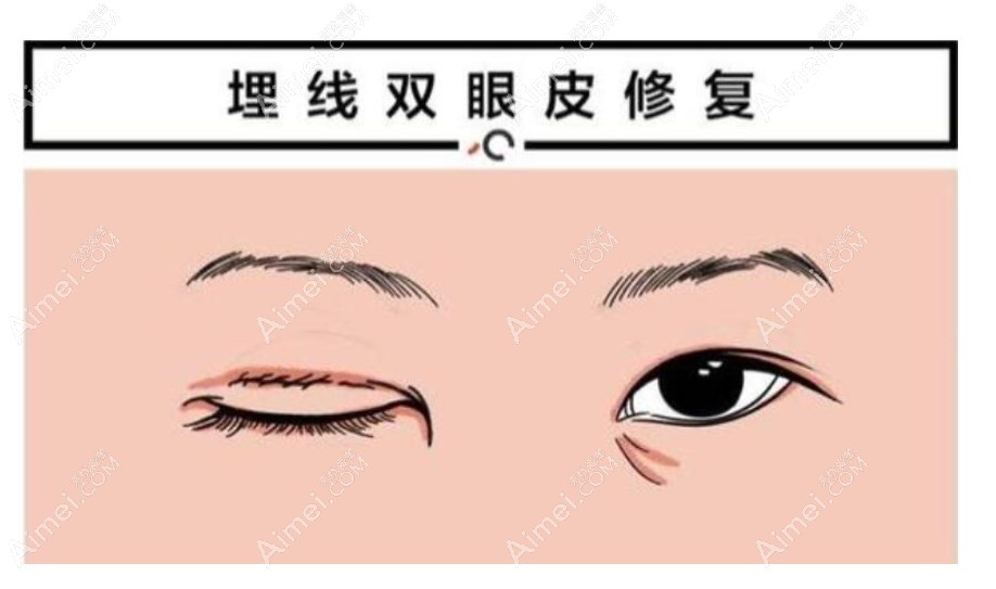 魏志香双眼皮修复技术好 魏志香双眼皮修复技术好