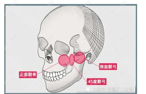 颧骨颧弓推多了怎么修复?补骨修复,玻尿酸or脂肪填充都可以