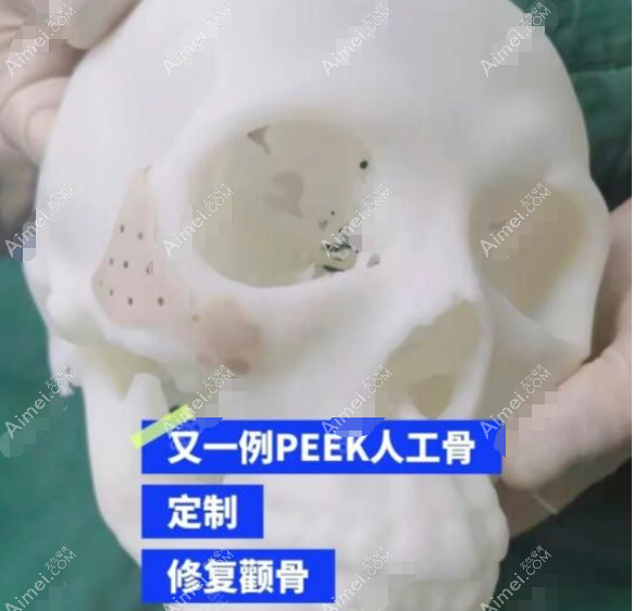 peek人工骨补骨修复颧骨怎么样