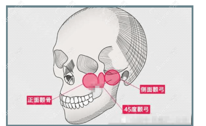 颧骨颧弓内推多了怎么修复