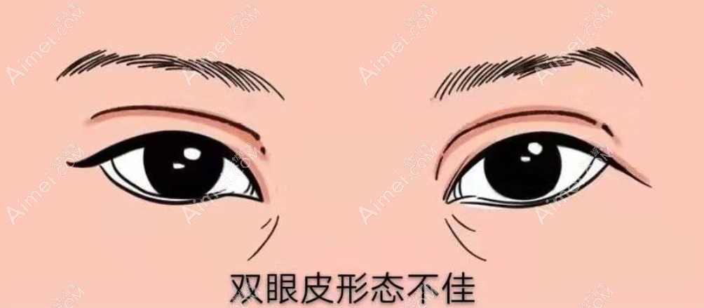 张冰洁眼修复实例 张冰洁眼修复实例