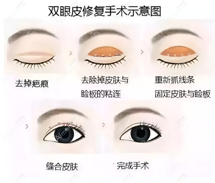 黄泽春双眼皮修复多少钱 黄泽春双眼皮修复多少钱