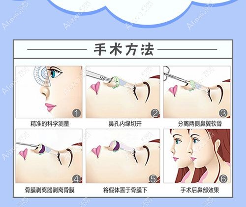 十大隆鼻假体品牌排行榜及价格,国产和进口常见品牌都有说