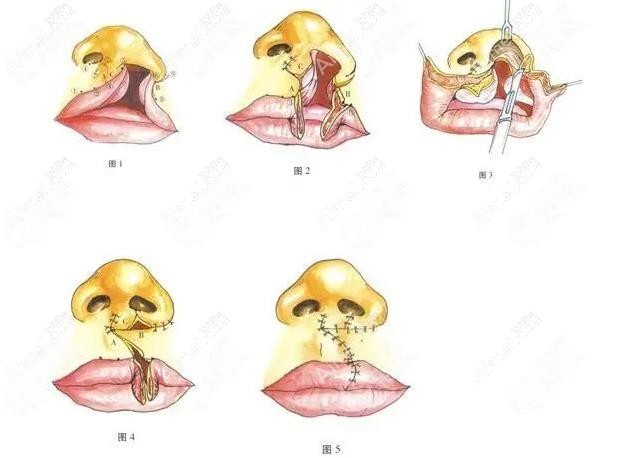 成人唇裂二期修复手术全过程视频:拆线后留白色疤痕能去掉