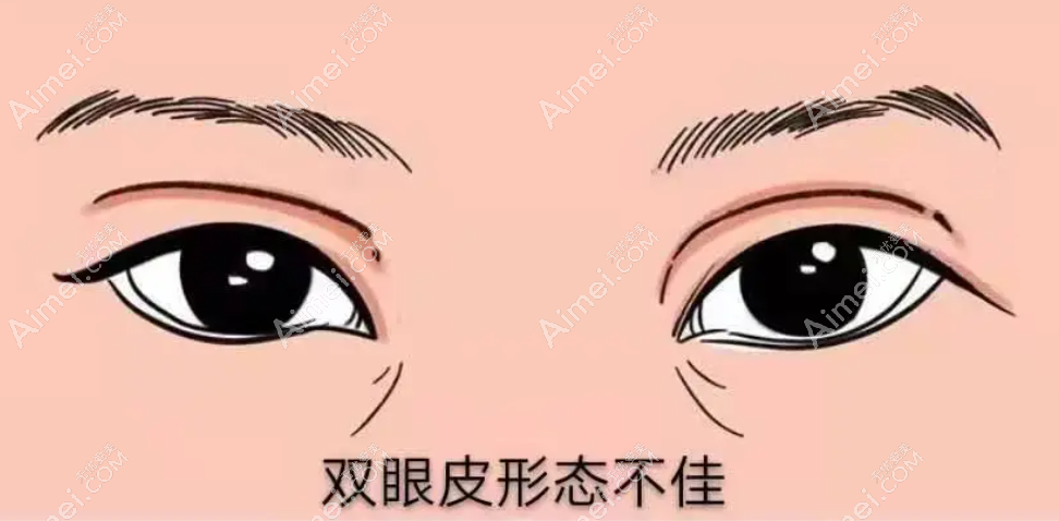 黄泽春医生各种双眼皮失败症状都能修复 黄泽春医生各种双眼皮失败症状都能修复