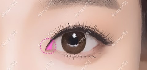 张冰洁眼角修复实例 张冰洁眼角修复实例