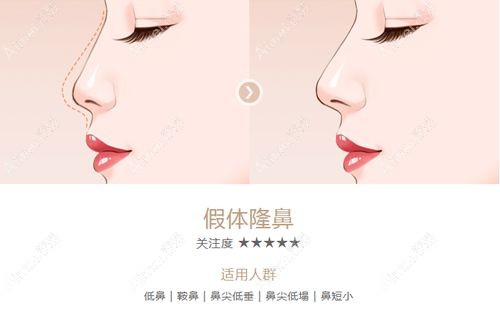 隆鼻假体品牌排行榜前十里国产和进口常见品牌各占一半m.dlren.com.jpg 隆鼻假体品牌排行榜前十里国产和进口常见品牌各占一半m.dlren.com.jpg
