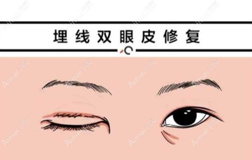 大连爱德丽格谁做眼皮好 大连爱德丽格谁做眼皮好