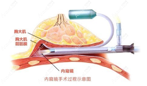 15分钟极速隆胸原理aimei。com 15分钟极速隆胸原理aimei。com