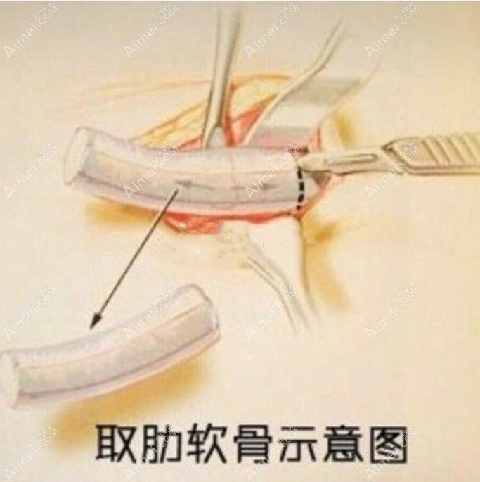 北京沃尔刘彦军做鼻子怎么样 北京沃尔刘彦军做鼻子怎么样