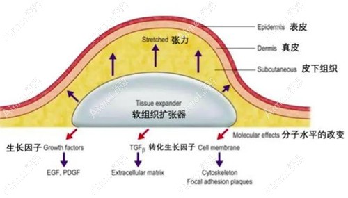 扩张器 扩张器