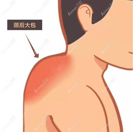 土麦森去富贵包手术技术图 土麦森去富贵包手术技术图