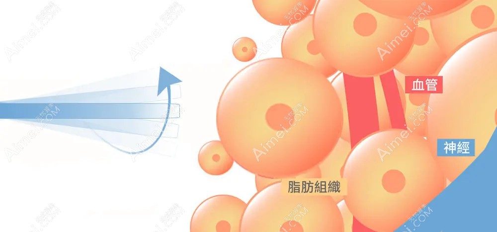 土麦森吸脂技术可靠 土麦森吸脂技术可靠