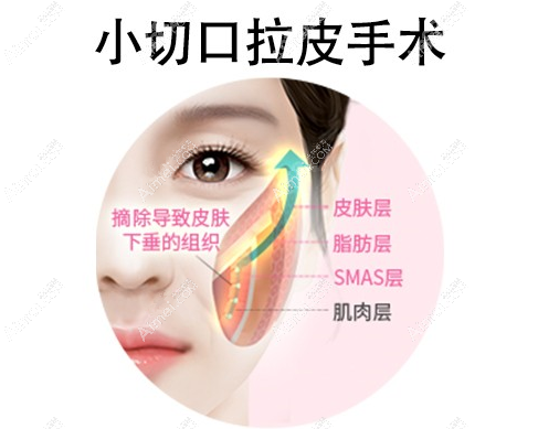 李晓东pst面部拉皮手术提升部位
