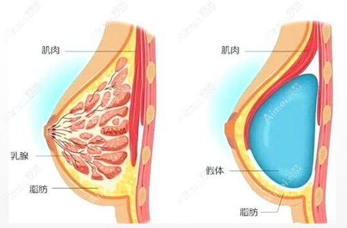 上海假体隆胸好的医生排名