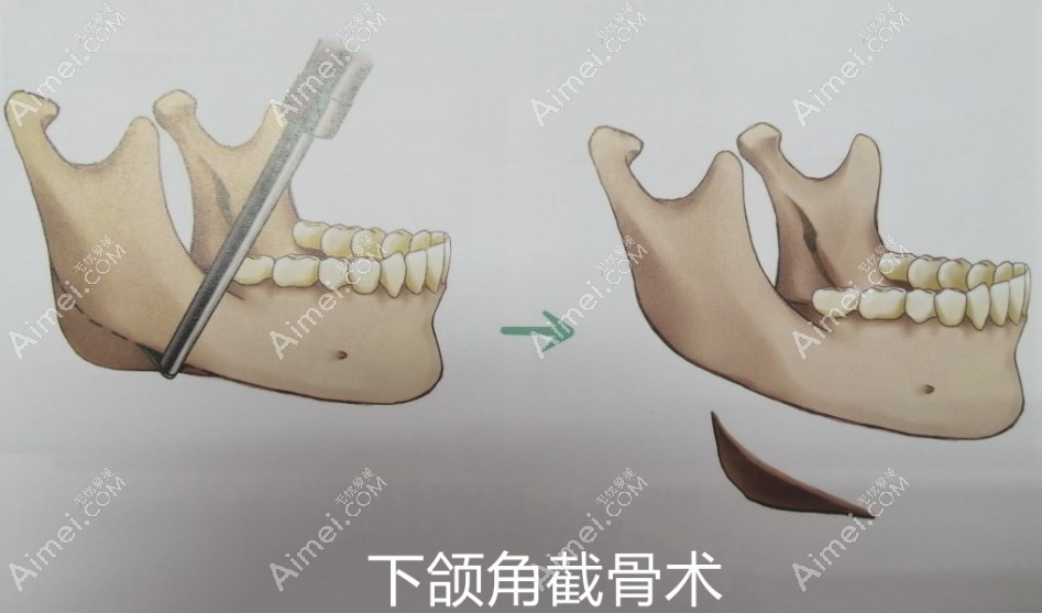 柳超磨骨三十分钟内完成 柳超磨骨三十分钟内完成
