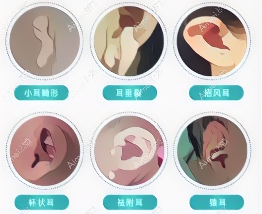 郭树忠耳再造手术改善耳畸形症状图解 郭树忠耳再造手术改善耳畸形症状图解