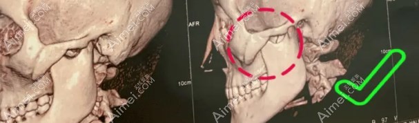 柳超颧骨内推实例 柳超颧骨内推实例