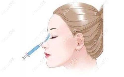生物活性玻璃隆鼻是骗局答疑m.dlren.com