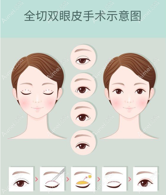 田毅医生和田芳斌医生谁双眼皮做得好 田毅医生和田芳斌医生谁双眼皮做得好