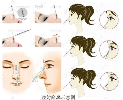 生物活性玻璃隆鼻原理