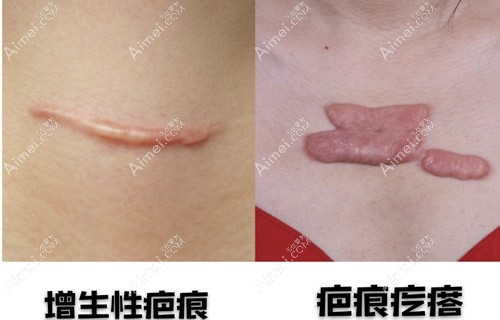 增生疤痕和疤痕疙瘩哪个好治疗?从外观看增生疤痕更容易治