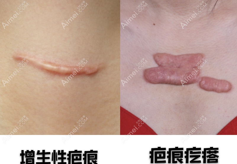 增生疤痕和疤痕疙瘩的图片对比 增生疤痕和疤痕疙瘩的图片对比