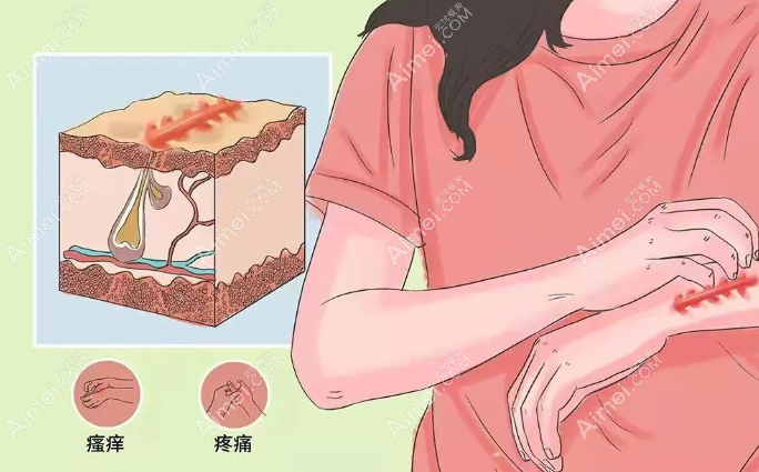 疤痕增生和废痕疙瘩一样吗 疤痕增生和废痕疙瘩一样吗