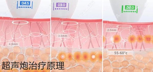 超声炮治疗原理 超声炮治疗原理