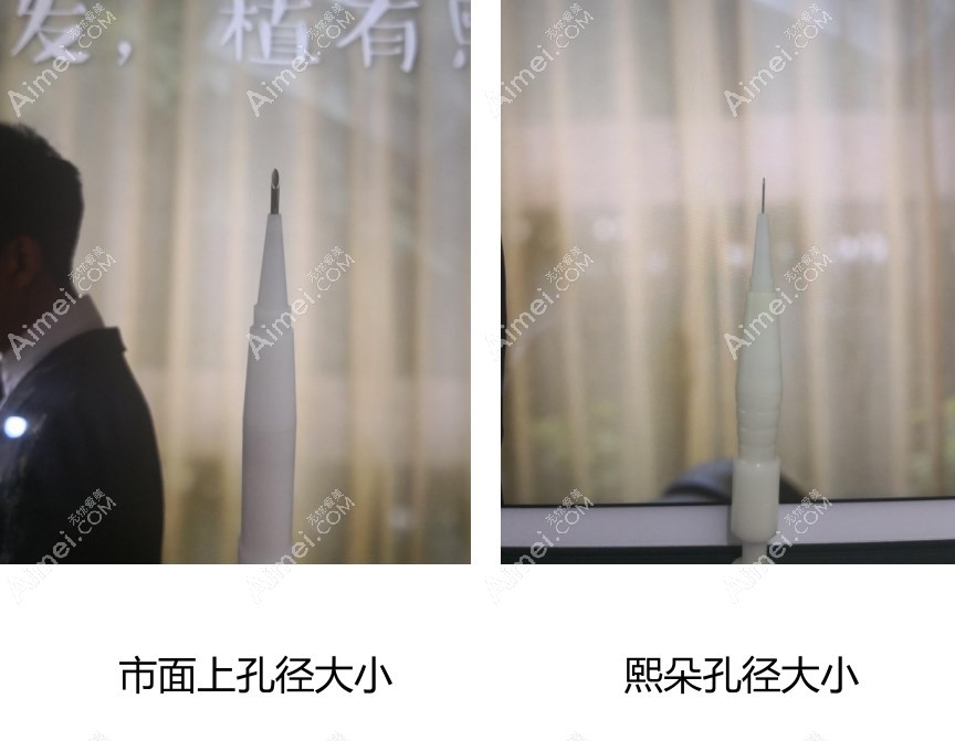 熙朵头发移植用是什么技术 熙朵头发移植用是什么技术