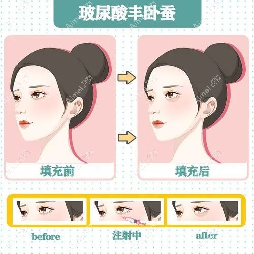 韩国卧蚕手术好的医院中韩国promise做丰卧蚕手术成效好www.aimei.com 韩国卧蚕手术好的医院中韩国promise做丰卧蚕手术成效好www.aimei.com