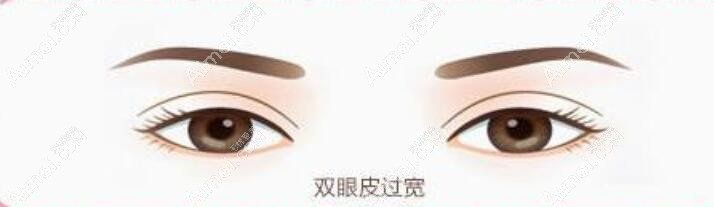 李光琴双眼皮宽降窄修复实例公开,真实评价:技术好价格16800+