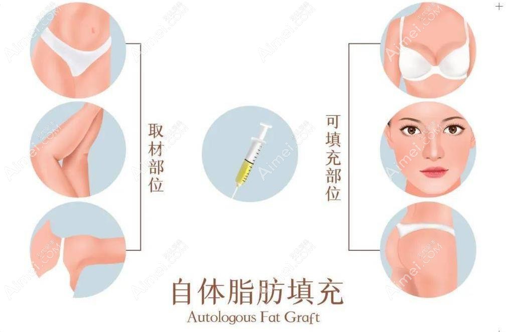 王自谦脂肪填充口碑好 王自谦脂肪填充口碑好