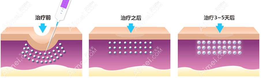 韩国陈整形外科自体真皮再生术治疗前后对比图@爱美网 韩国陈整形外科自体真皮再生术治疗前后对比图@爱美网