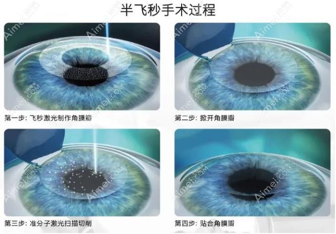 从半飞秒和全飞秒的利弊解析哪个好,都有干眼风险但可避免