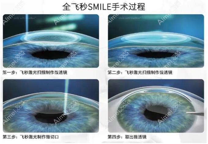 全飞秒手术的优缺点 全飞秒手术的优缺点