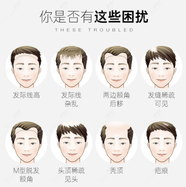 厦门万禾丽生植发技术怎么样 厦门万禾丽生植发技术怎么样