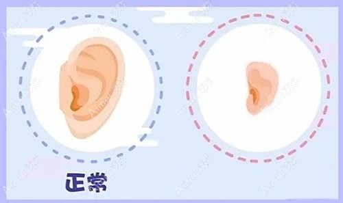 广州做小耳畸形好的医院推荐:广州高尚做外耳再造好费用低