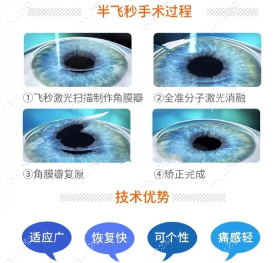 半飞秒近视手术过程 半飞秒近视手术过程