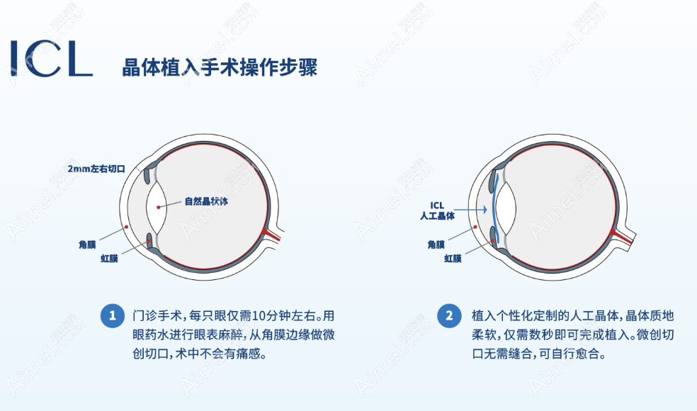 icl晶体植入近视手术怎么做 icl晶体植入近视手术怎么做
