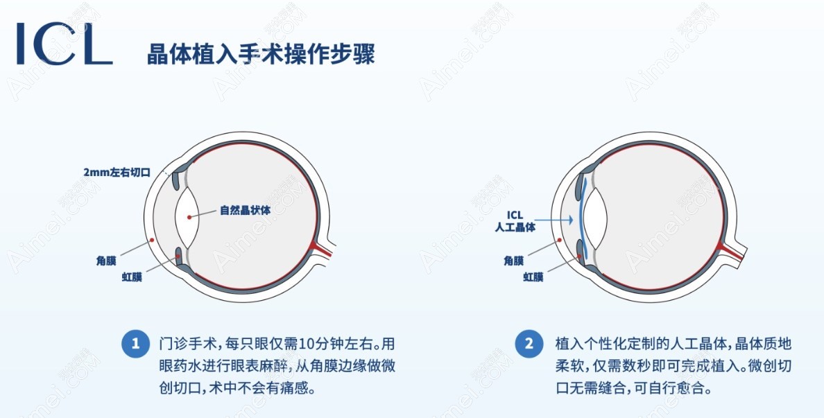 晶体植入近视手术费用 晶体植入近视手术费用