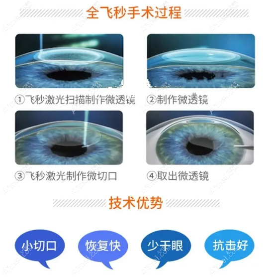 全飞秒近视手术 全飞秒近视手术